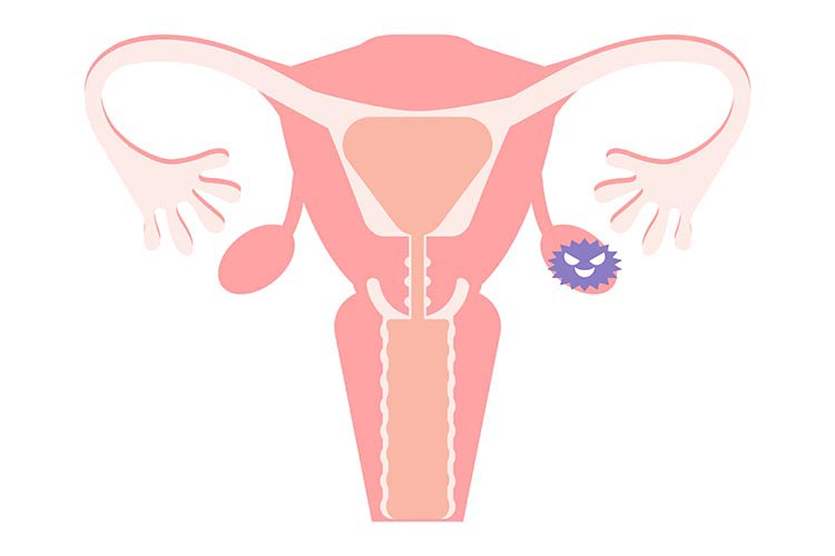 卵巣腫瘍のイメージ画像
