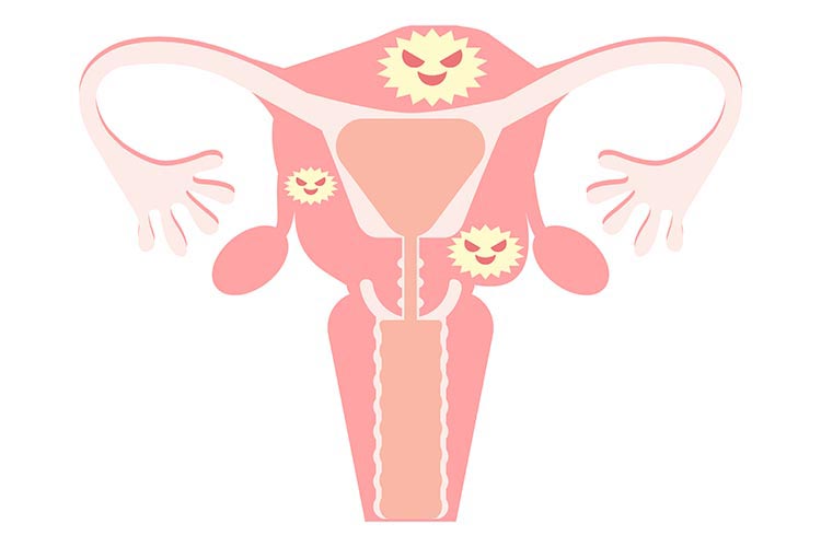子宮筋腫のイメージ画像